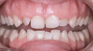 Smile Gallery page. Dental crowns, 6 months smiles and whitening before photo