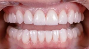 Smile Gallery page. After photo of Infinite Smiles client with veneers and whitening.