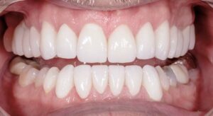 Smile Gallery page. Veneers and whitening after photo