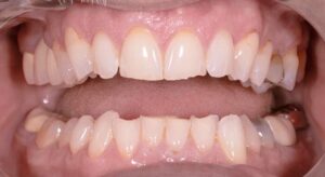 Smile Gallery page. Veneers and whitening before photo