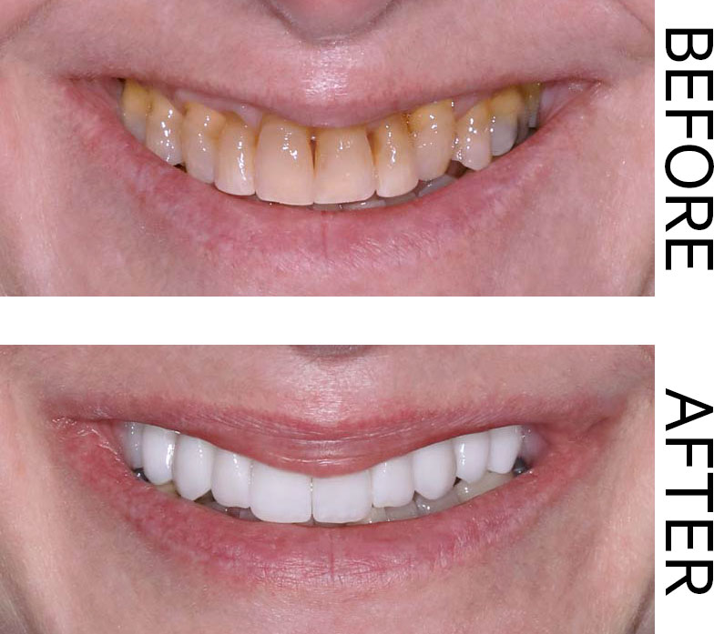 A before-and-after showing the effects of tooth decay and the results of proper cleaning, dental veneers, and tooth whitening. Image for the debunking dental myths blog post