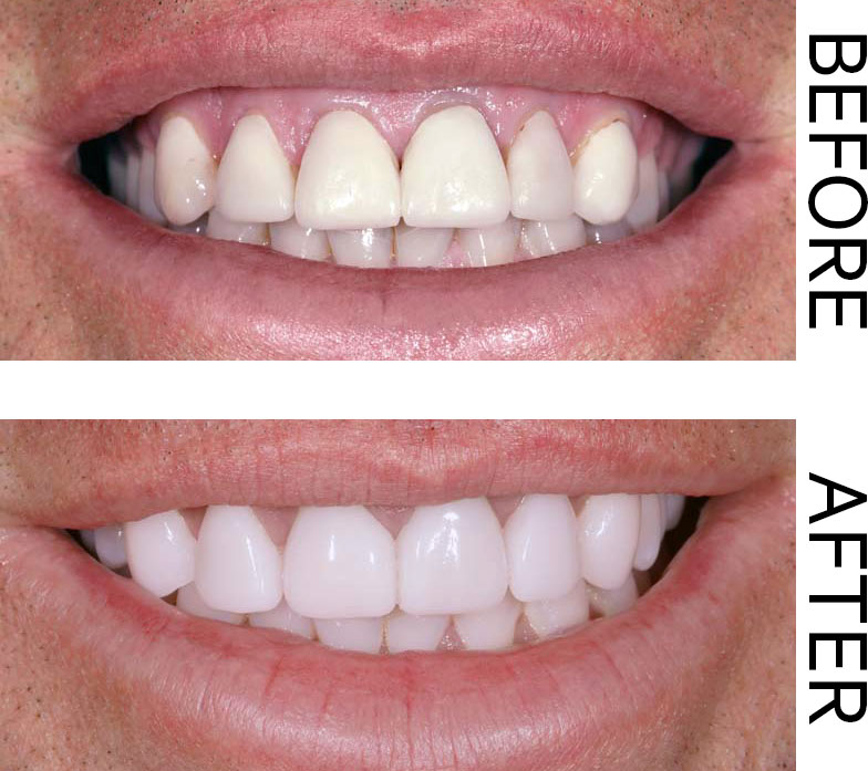 A before-and-after showing a client before and after receiving tooth whitening. Image for the debunking dental myths blog post