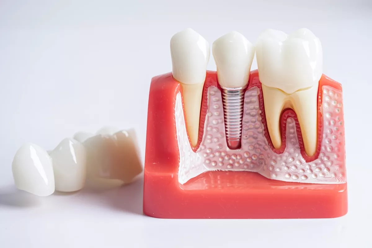 A model of teeth with an implant.