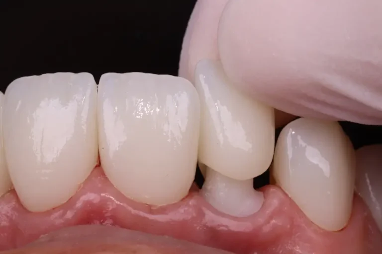 A close-up on a porcelain crown