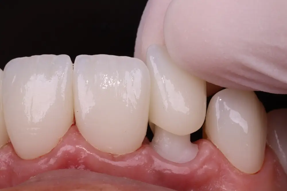 A close-up on a porcelain crown